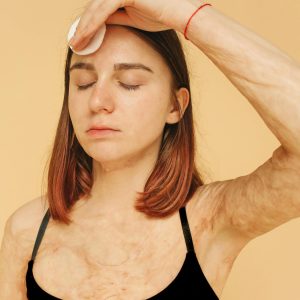 Anti Fungal & Burning