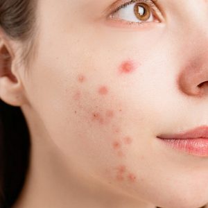 Anti Mark & Pimple Care